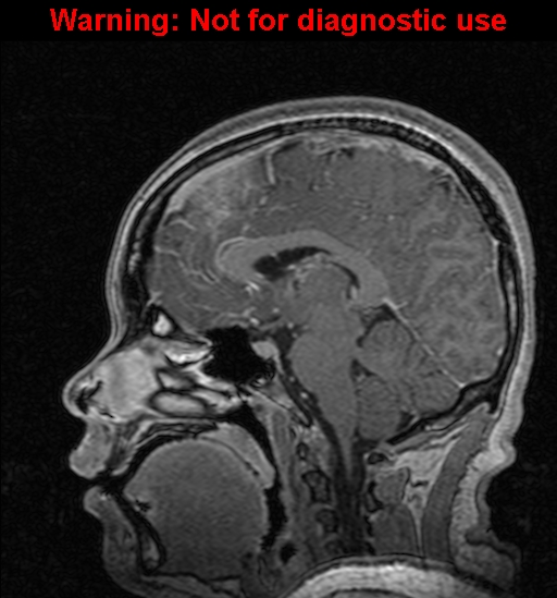 Cerebral venous thrombosis (Radiopaedia 37224-39208 Sagittal T1 C+ 74).jpg