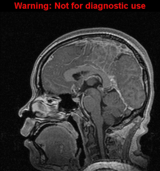 Cerebral venous thrombosis (Radiopaedia 37224-39208 Sagittal T1 C+ 77).jpg