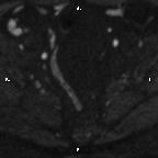 Cervical adenocarcinoma (Radiopaedia 65011-73985 Axial DWI 71).jpg