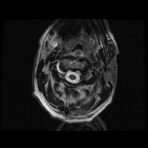File:Cervical canal stenosis with cord compression (Radiopaedia 34114-35374 Axial T2 33).png