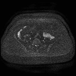 Cervical carcinoma (Radiopaedia 85405-101028 Axial DWI 80).jpg