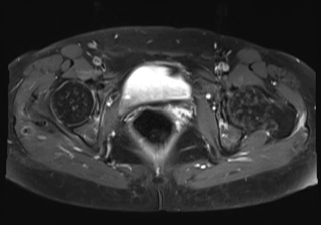 File:Cervical carcinoma (Radiopaedia 88312-104943 Axial T1 C+ fat sat 16).jpg