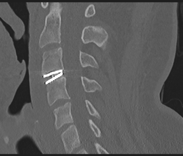 Cervical disc replacement (Radiopaedia 44025-47541 Sagittal bone window 46).png