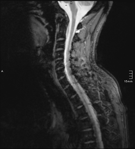 File:Cervical dural CSF leak on MRI and CT treated by blood patch (Radiopaedia 49748-54995 D 7).png