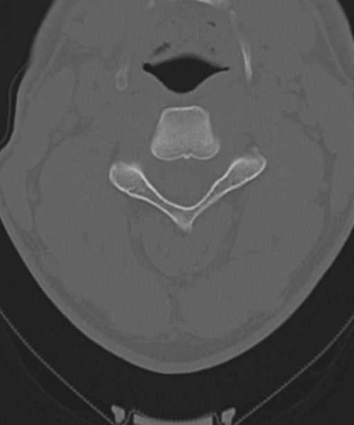 Cervical intercalary bone (Radiopaedia 35211-36748 Axial bone window 27).png