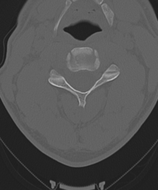Cervical intercalary bone (Radiopaedia 35211-36748 Axial bone window 28).png