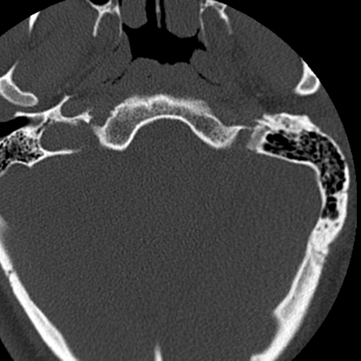 Cervical schwannoma (Radiopaedia 57979-64974 Axial bone window 5).png