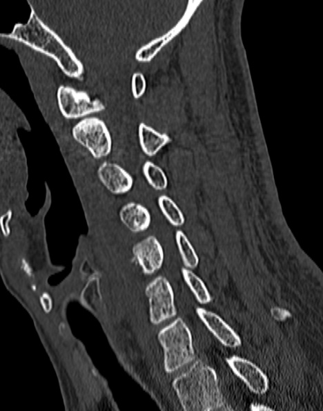 File:Cervical spondylodiscitis (Radiopaedia 28057-29489 Sagittal bone window 29).jpg