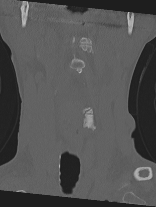 Cervical spondylolysis (Radiopaedia 49616-54811 Coronal bone window 7).png