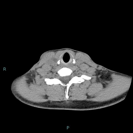 Cervical thymic cyst (Radiopaedia 88632-105335 Axial non-contrast 44).jpg
