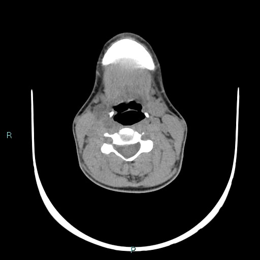 File:Cervical thymic cyst (Radiopaedia 88632-105335 Axial non-contrast 65).jpg