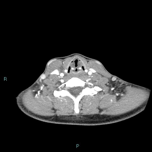 Cervical thymic cyst (Radiopaedia 88632-105335 B 45).jpg