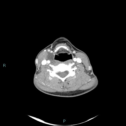 Cervical thymic cyst (Radiopaedia 88632-105335 B 55).jpg
