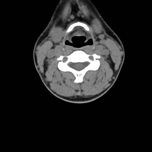 Chiari I malformation and obstructive hydrocephalus (Radiopaedia 41185-43981 D 53).png