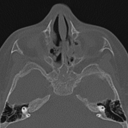Choanal atresia (Radiopaedia 88525-105975 Axial bone window 52).jpg