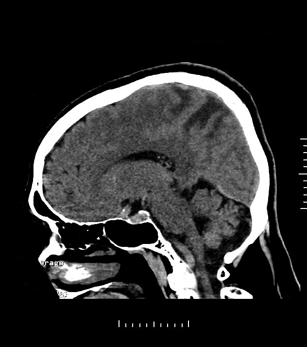Cholangiocarcinoma with cerebral metastases (Radiopaedia 83519-98628 C 24).jpg