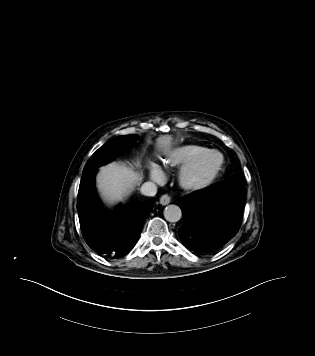 Cholangiocarcinoma with cerebral metastases (Radiopaedia 83519-98629 Axial C+ delayed 8).jpg