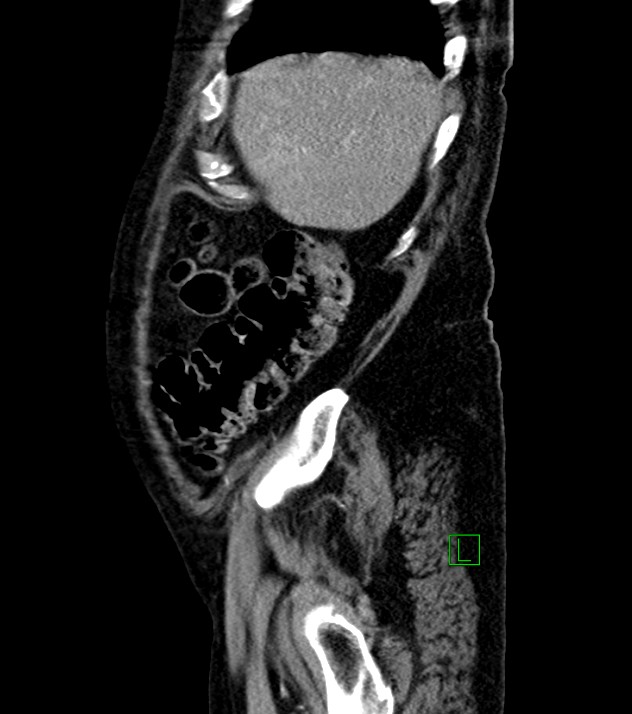 Cholangiocarcinoma with cerebral metastases (Radiopaedia 83519-98629 F 100).jpg