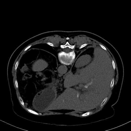 File:Cholecystitis - CT IVC obstructive choledocholitiasis (Radiopaedia 43966-47479 Axial Biliscopin 32).png