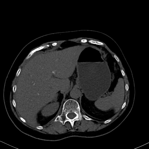 File:Cholecystitis - obstructive choledocholitiasis (CT intravenous cholangiography) (Radiopaedia 43966-47479 Axial 101).png