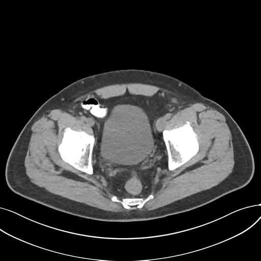 File:Cholecystitis with focal perforation and hepatic abscess (Radiopaedia 37189-38945 Axial non-contrast 77).png