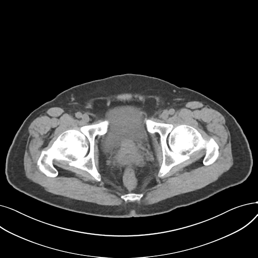 Cholecystitis with focal perforation and hepatic abscess (Radiopaedia 37189-38945 Axial non-contrast 82).png