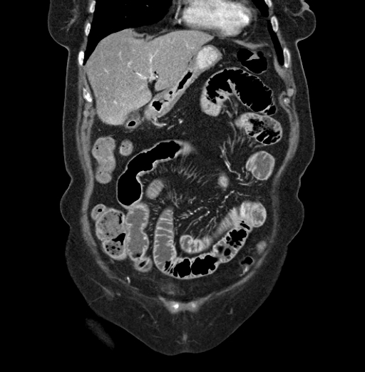 File:Cholecystoduodenal fistula due to calculous cholecystitis with gallstone migration (Radiopaedia 86875-103077 B 13).jpg