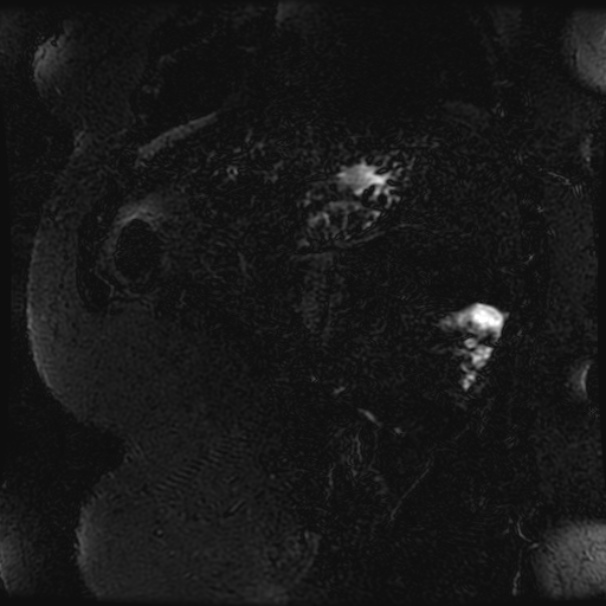 Choledocholithiasis on CT and MRI (Radiopaedia 24825-25088 Coronal T2 102).jpg