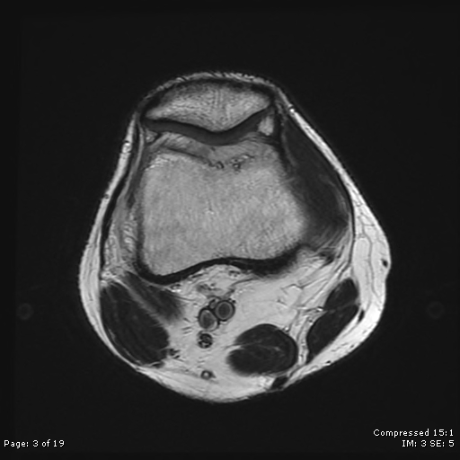 File:Chondroblastoma (Radiopaedia 25725-25891 Axial T2 3).jpg
