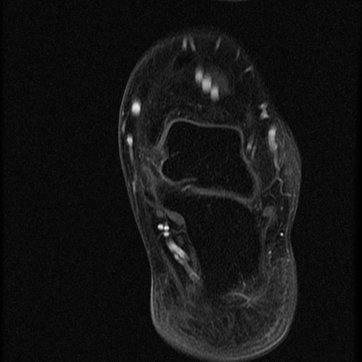File:Chondroblastoma - midfoot (Radiopaedia 64831-73765 G 1).jpg