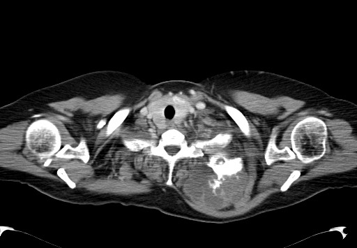 File:Chondrosarcoma - chest wall (Radiopaedia 65192-74199 C 5).jpg