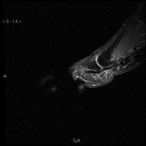 File:Chondrosarcoma - phalanx (Radiopaedia 69047-78813 Sagittal PD fat sat 14).jpg