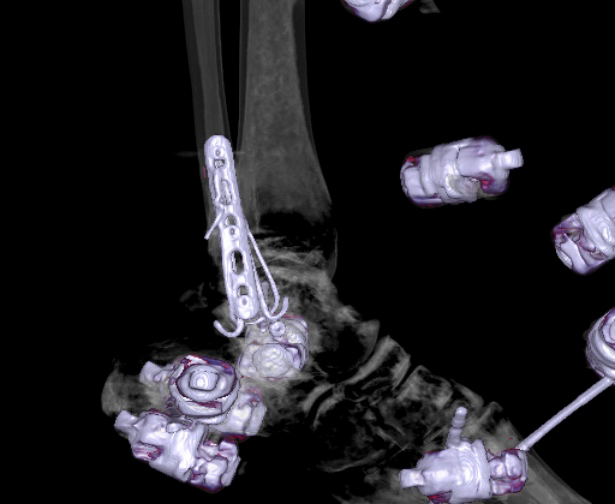 File:Chopart fracture (Radiopaedia 35347-36861 3D MPR bone window 28).jpg