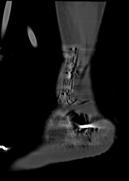 Chopart fracture (Radiopaedia 35347-36861 Sagittal bone window 62).jpg