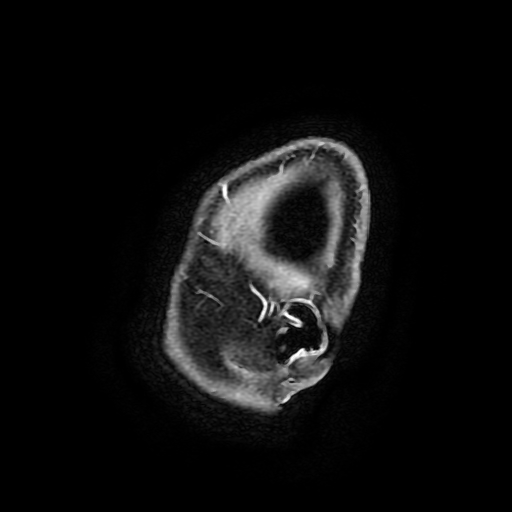 Chordoid glioma of third ventricle (Radiopaedia 91612-109340 F 198).jpg