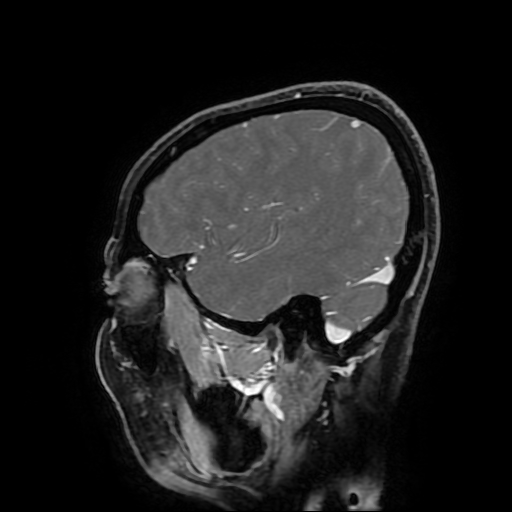 Chordoid glioma of third ventricle (Radiopaedia 91612-109340 F 54).jpg