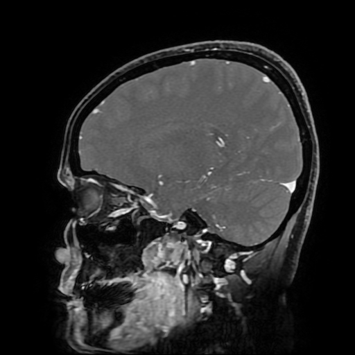 Chordoid glioma of third ventricle (Radiopaedia 91612-109340 F 82).jpg