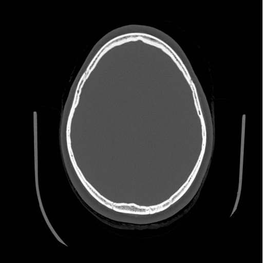 Choroid plexus papilloma extending into the cerebellopontine angle cistern (Radiopaedia 85941-101833 Axial bone window 67).png