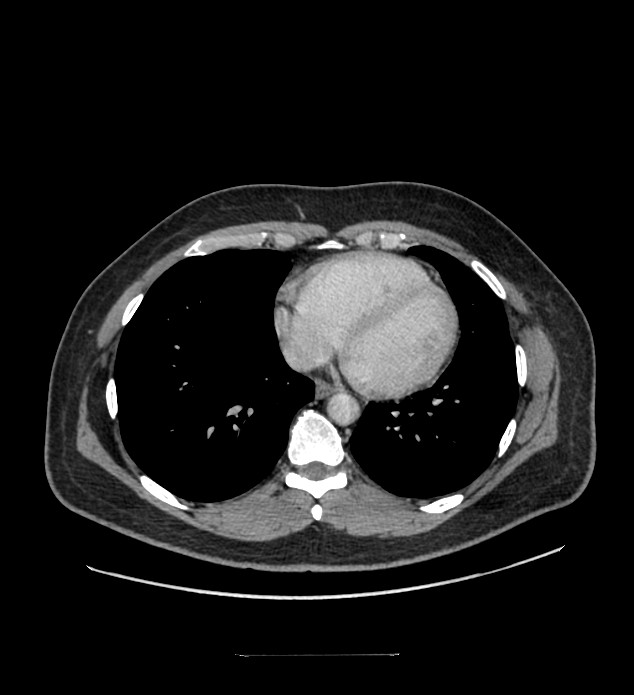 Chromophobe renal cell carcinoma (Radiopaedia 84337-99644 C 4).jpg