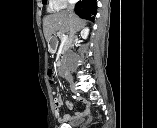 Chronic contained rupture of abdominal aortic aneurysm with extensive erosion of the vertebral bodies (Radiopaedia 55450-61901 B 15).jpg