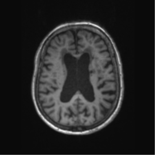 Chronic hypertensive encephalopathy (Radiopaedia 72844-83495 Axial T1 29).png