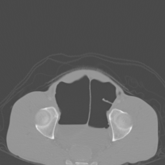 Chronic large bowel pseudo-obstruction (Radiopaedia 43181-46492 Axial bone window 150).jpg