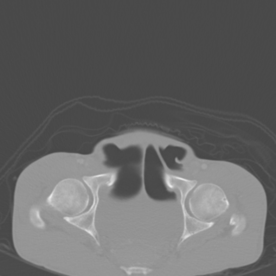 Chronic large bowel pseudo-obstruction (Radiopaedia 43181-46492 Axial bone window 156).jpg