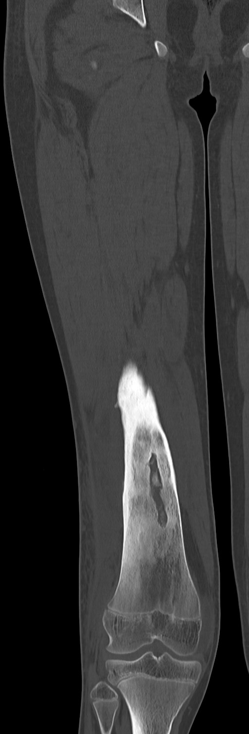 Chronic ostemyelitis of the femur with long sinus tract (Radiopaedia 74947-85982 Coronal bone window 47).jpg