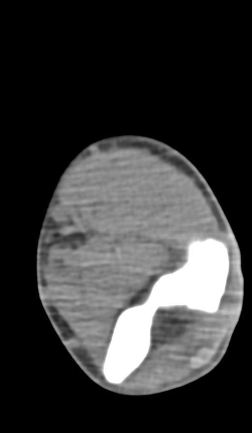 Chronic osteomyelitis of the distal humerus (Radiopaedia 78351-90971 Axial non-contrast 89).jpg