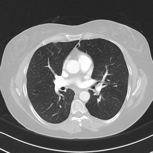 Chronic pulmonary embolus (Radiopaedia 39129-41341 Axial lung window 32).png