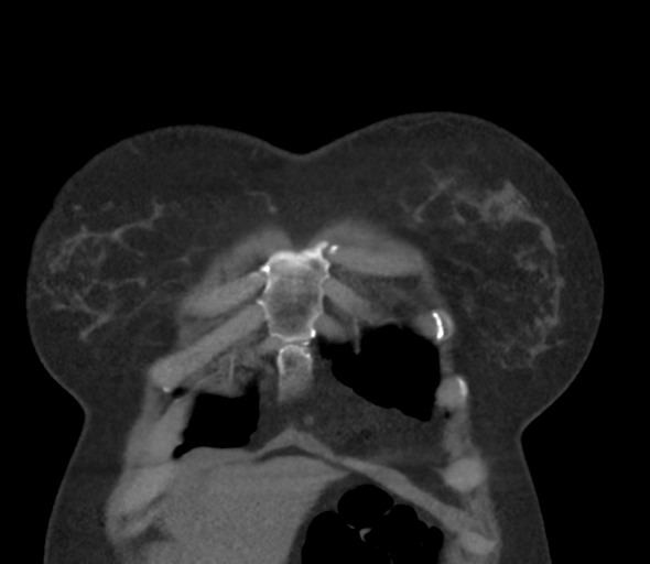 Chronic pulmonary embolus (Radiopaedia 39129-41341 Coronal C+ CTPA 13).png