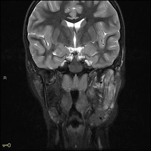 File:Chronic reactive multifocal osteomyelitis (CRMO) - mandible (Radiopaedia 56405-63069 Coronal STIR 20).jpg