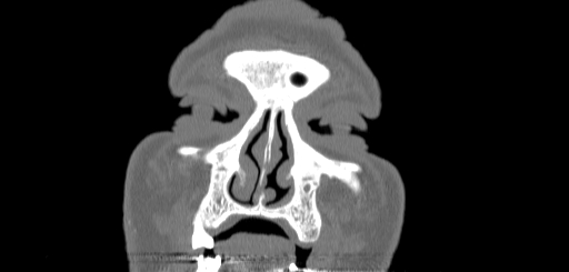 Chronic sphenoidal sinusitis (Radiopaedia 62030-70122 Coronal bone window 14).jpg