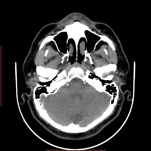 Chronic submandibular sialolithiasis (Radiopaedia 69817-79814 Axial non-contrast 9).jpg